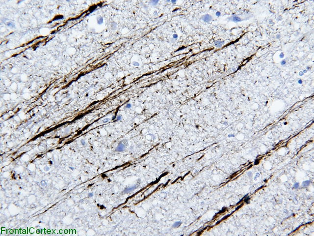 Ischemic axonal damage, beta amyloid immunostaining x 100